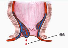 便血2.jpg
