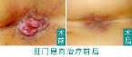 肛门息肉.jpg