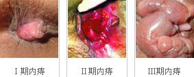 内痔的 治疗方法